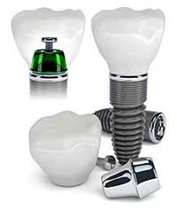 Upper West Side Dental Implants